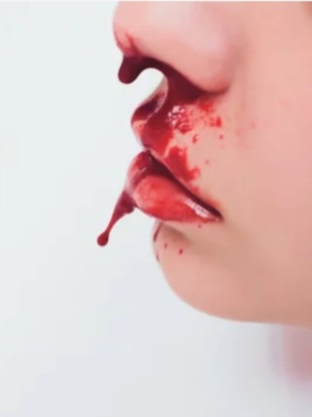 NOSE BLEED