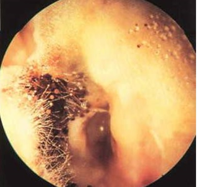 ASPERGILLUS NIGER IN EAR