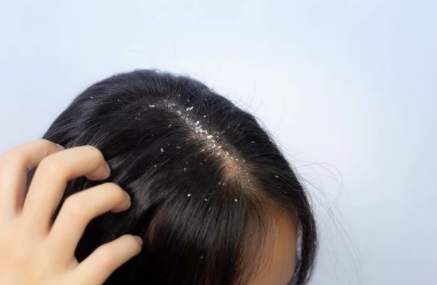 HAIR WITH DANDRUFF