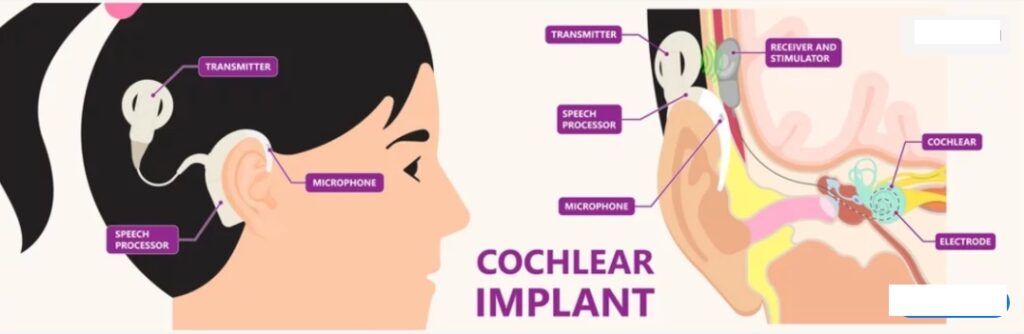 Cochlear implant surgery for Earphones Cause Hearing Loss