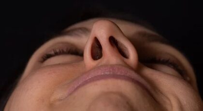 Deviated Nasal Septum