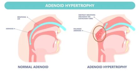 ADENOIDS