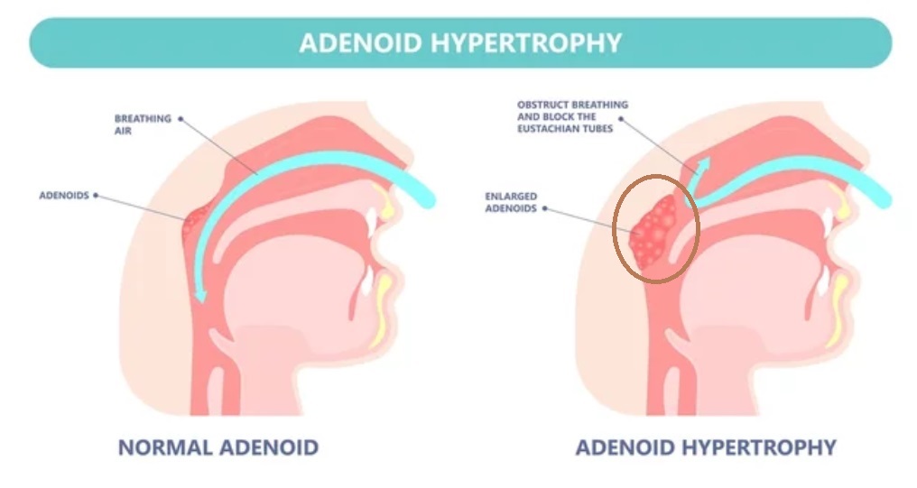 ADENOIDS