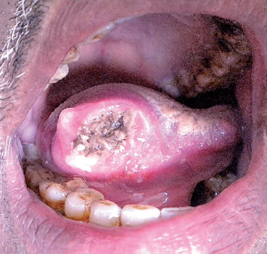 Signs of Mouth Cancer