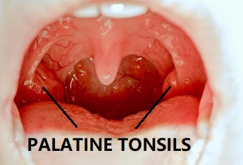 Adult Tonsillitis - Dr Sharad ENT