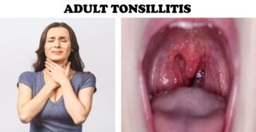 ADULT TONSILLITIS