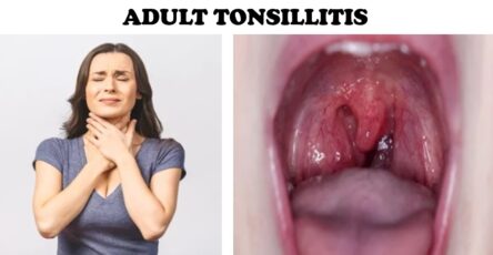 ADULT TONSILLITIS