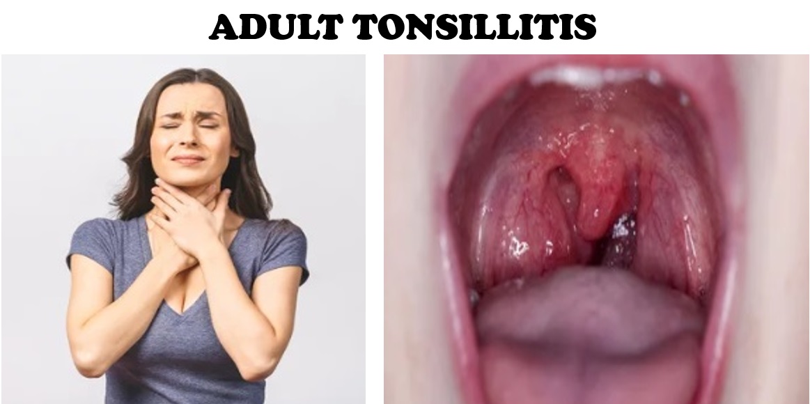 ADULT TONSILLITIS