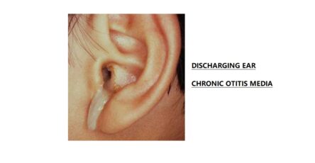 Chronic Otitis Media