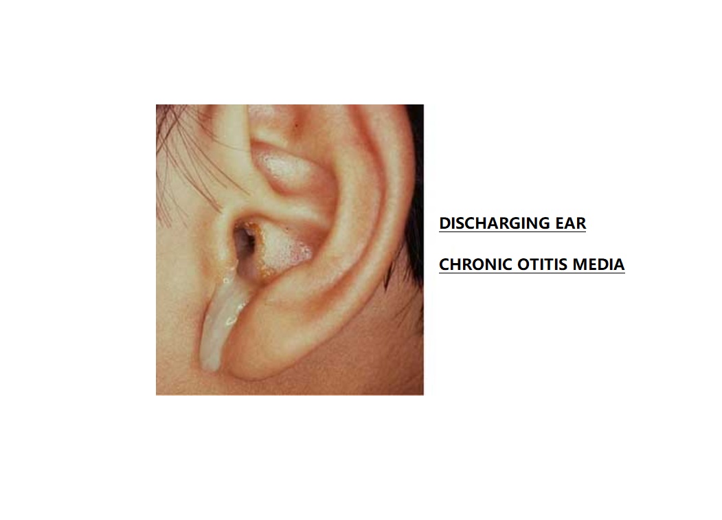 Chronic Otitis Media