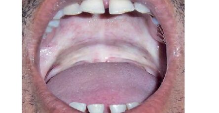 Oral Submucous Fibrosis