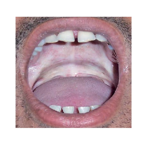 Oral Submucous Fibrosis