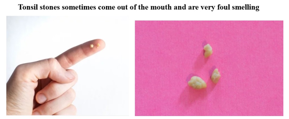 What Are Tonsil Stones And Why Do They Cause Bad Breath Dr Sharad Ent
