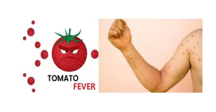 TOMATO FEVER