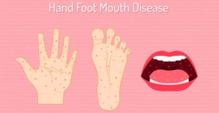 Hand, Foot, and Mouth Disease (HFMD)