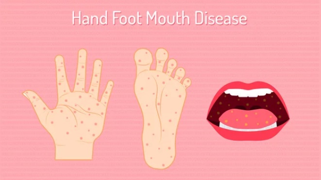 Hand, Foot, and Mouth Disease (HFMD)