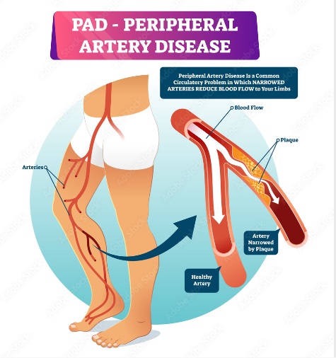 PERIPHERAL ARTERY DISEASE in Cold Intolerance