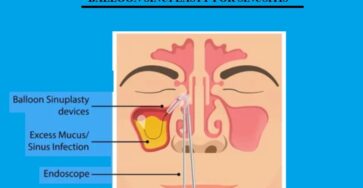 BALLOON SINUPLASTY