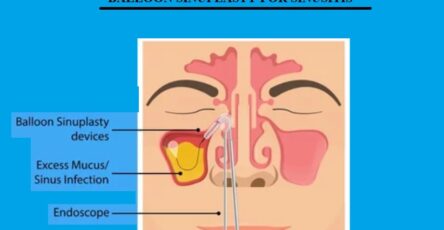 BALLOON SINUPLASTY