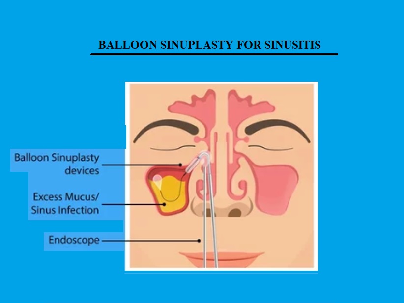 BALLOON SINUPLASTY