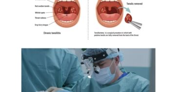 tonsillectomy surgery