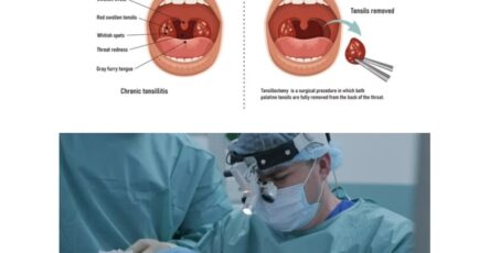 tonsillectomy surgery