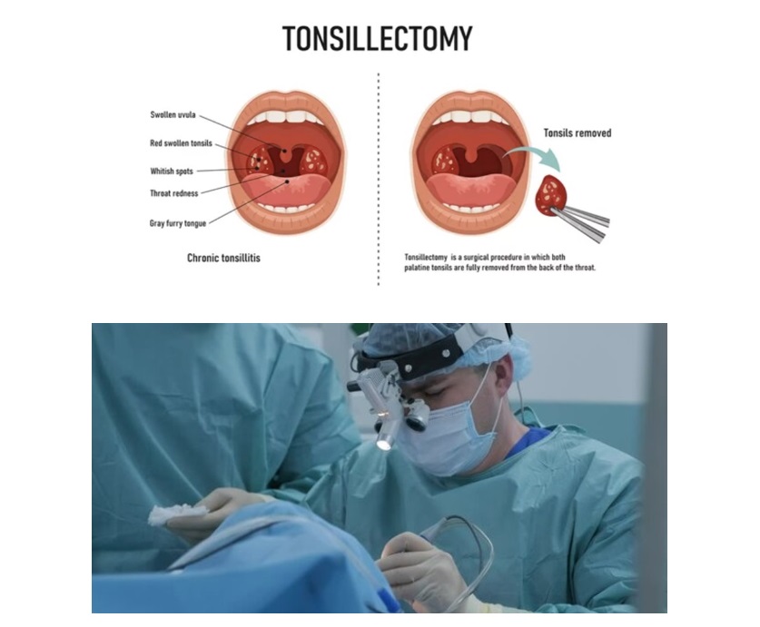 tonsillectomy surgery