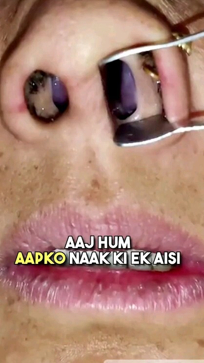 Do you get worried seeing this inside the nose ll Inferior turbinates v/s Nasal Mass reels medical nose mass inferiorturbinate health healthcare nasalmass otorhinolaryngology entspecialist rhinology patient patientcare fact factbytes knowledge knowledgeispower bestentdoctor ai texttospeech aivoice