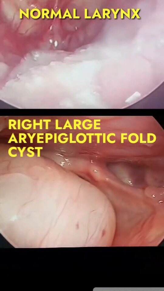 Throat Discomfort ll Sensation of foreign body stuck in throat ll A constant urge to clear the throat reels reelsinstagram medical health voice mbbs entdoctor entpg otorhinolaryngology otorhinolaryngologist throatdiscomfort foreignbodysensation cyst