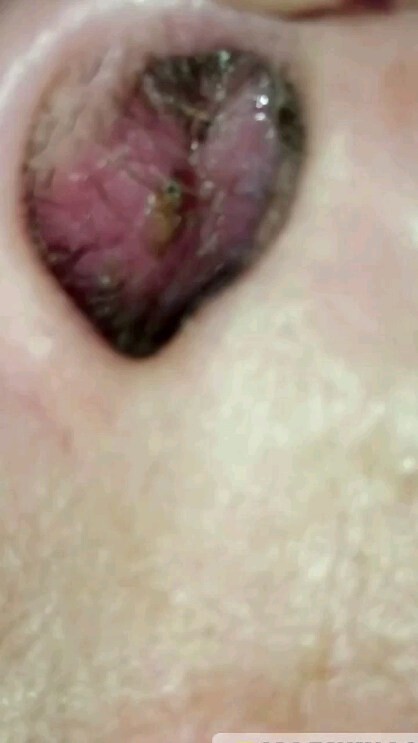 Pimple or Boil in the nose || Nasal furunculosis ll Nasal Folliculitis reelsinstagram reels furuncle boil pimple health nose infection pain medical medicine entspecialist entdoctor otorhinolaryngology