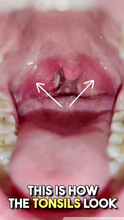 Tonsillitis || Tonsil infection || Throat pain || Sore throat || Tonsillopharyngitis || Pharyngitis reels reelsinstagram medical medicine tonsil tonsillitis pharyngitis health entdoctor entspecialist otorhinolaryngology pgent entpostings earnosethroat earnoseandthroat